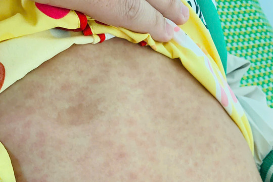 Quảng Nam tăng cường biện pháp phòng chống dịch sởi